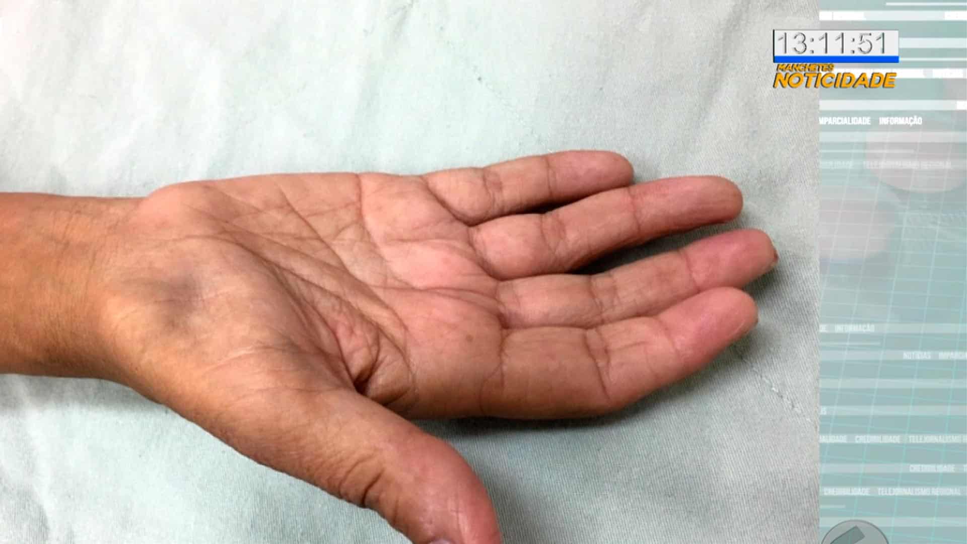Síndrome do túnel do carpo: 150 mil casos por ano no Brasil