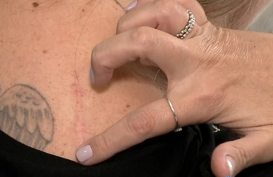 185 mil novos casos de câncer de pele são diagnosticados por ano no Brasil