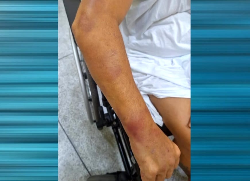 Imagem de braço da vítima com hematomas.