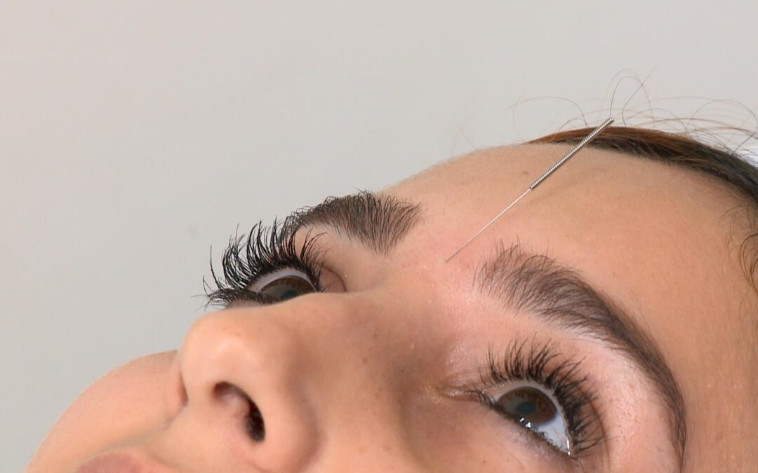 UBSs de Sorocaba oferecem terapias integrativas como acupuntura e auriculoterapia