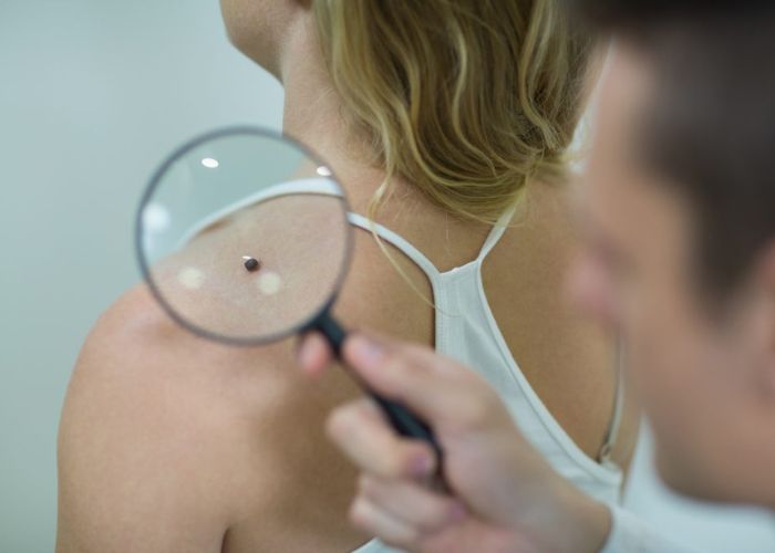 C&acirc;ncer de pele