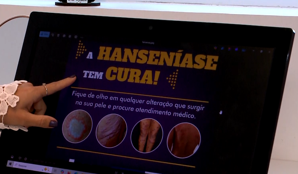 Banner da Hansen&iacute;ase.