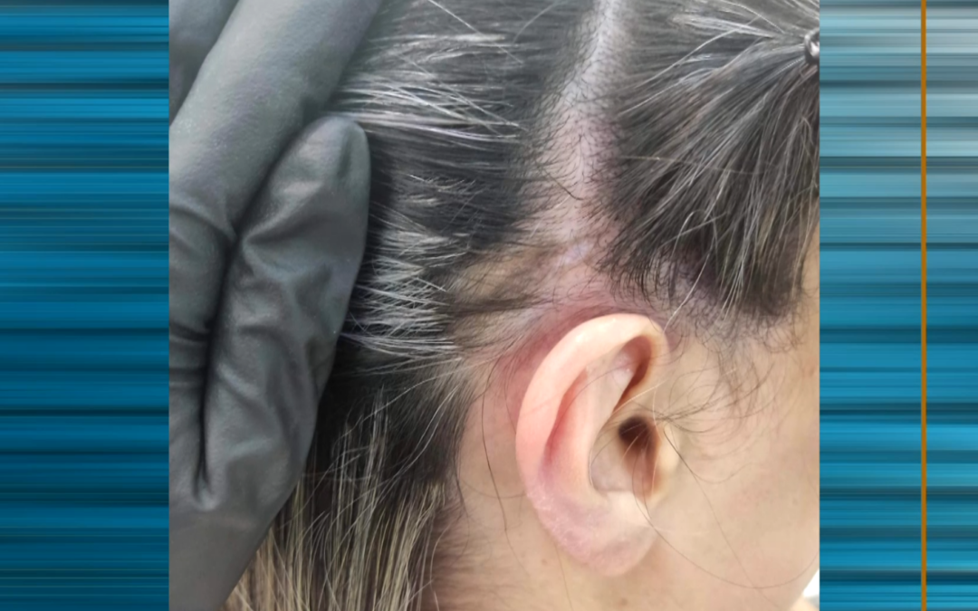 Lúpus exige atenção aos sinais do corpo e diagnóstico precoce pode fazer diferença no tratamento